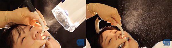 口腔外バキューム